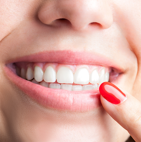 Close up of smile after receiving veneers