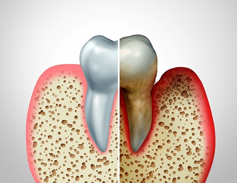 diagram comparison between healthy gums and periodontal disease