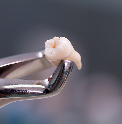 Extracted tooth held in forceps