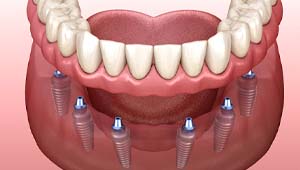 diagram of All-on-X implant dentures in Midland showing how they work