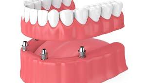 diagram of All-on-4 implants in Midland