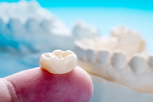 Close up of a dental crown resting on a dentist’s fingertip