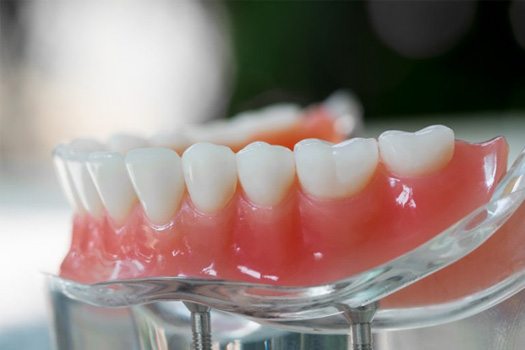 Lower implant denture sitting on a clear display stand