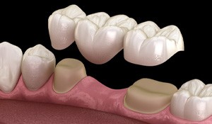 diagram of a dental bridge being placed 