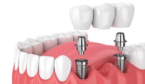 diagram of an implant bridge  