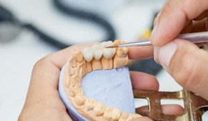 closeup of a dental bridge on model of a patient’s teeth   