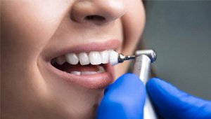 closeup of teeth being polished 