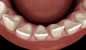 a digital illustration of gapped teeth