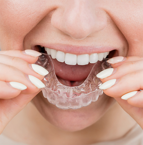 Putting in a clear aligner in Midland