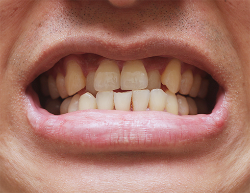 Close up of smile with open bite