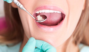 Closeup of smile during dental exam