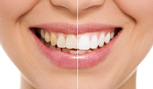Closeup smile half before and half after teeth whitening