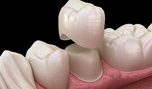 diagram of a dental crown