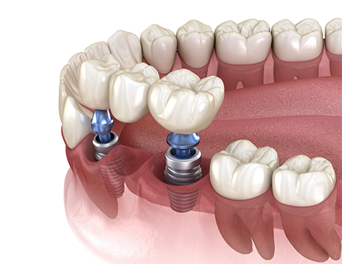 Illustration of dental bridge being attached to dental implant