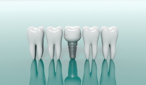 Model teeth lined up next to a single tooth dental implant in Midland