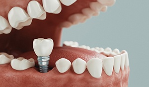 Diagram of how dental implants in Midland are placed