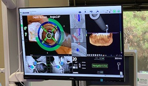 Screen showing computer-guided dental implant surgery in Midland