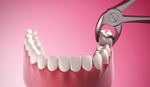 diagram showing the process of tooth extraction in Midland