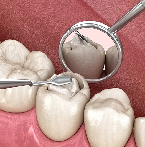 diagram showing what filling material looks like