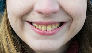 Alt image tag: woman with discolored teeth because of fluorosis