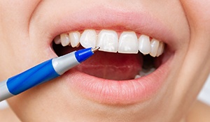 Alt image tag: pen pointing to fluorosis discoloration on patient’s teeth