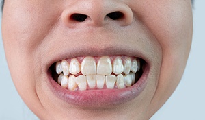 Alt image tag: teeth that have been discolored from fluorosis