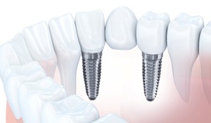 implant-retained bridge