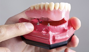 An image of an implant-supported denture