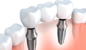 An image of an implant-supported bridge