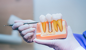 dentist explaining dental implants