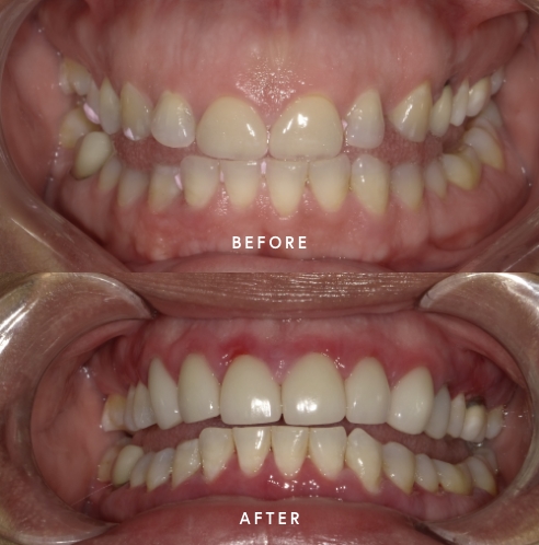 Close up of teeth before and after treatment