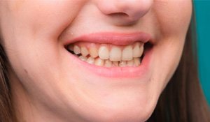 : a person struggling with fluorosis smiling in Midland