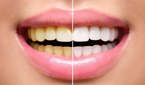 An image of before and after teeth whitening.