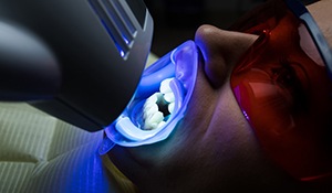 patient with guards and in-office whitening light