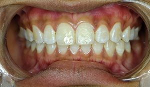 closeup of teeth with fluorosis