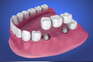 implant-retained bridge