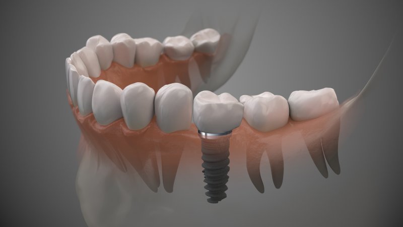 a digital image of a lower arch of teeth and a dental implant between two natural teeth