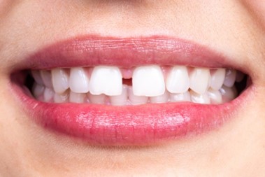 Picture of a smile with a diastema.