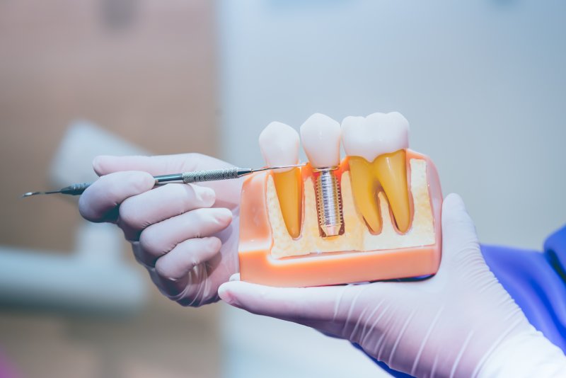 a display of teeth and dental implants